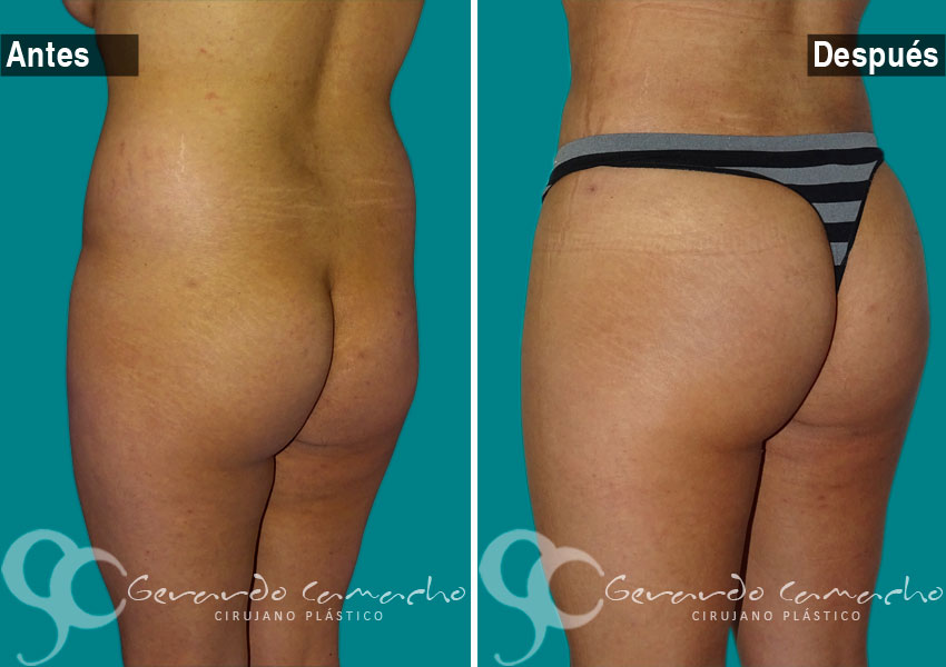 Gluteoplastia para resultados duraderos en Bogotá